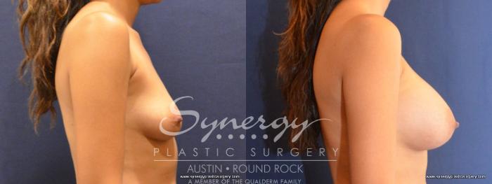 Before & After Breast Augmentation Case 457 View #2 View in Austin, TX