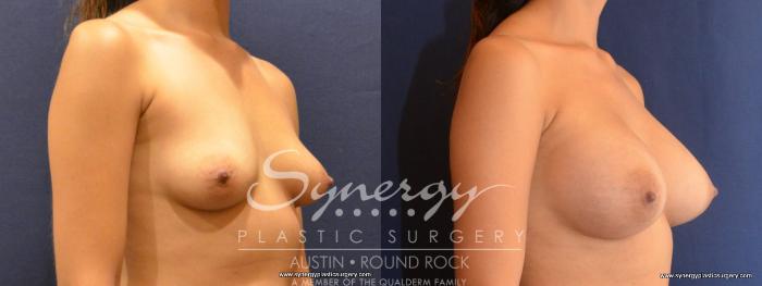 Before & After Breast Augmentation Case 457 View #3 View in Austin, TX