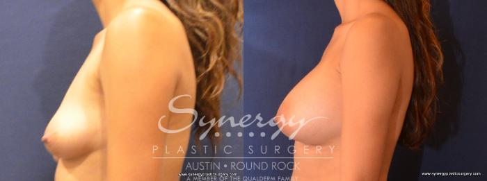 Before & After Breast Augmentation Case 457 View #4 View in Austin, TX
