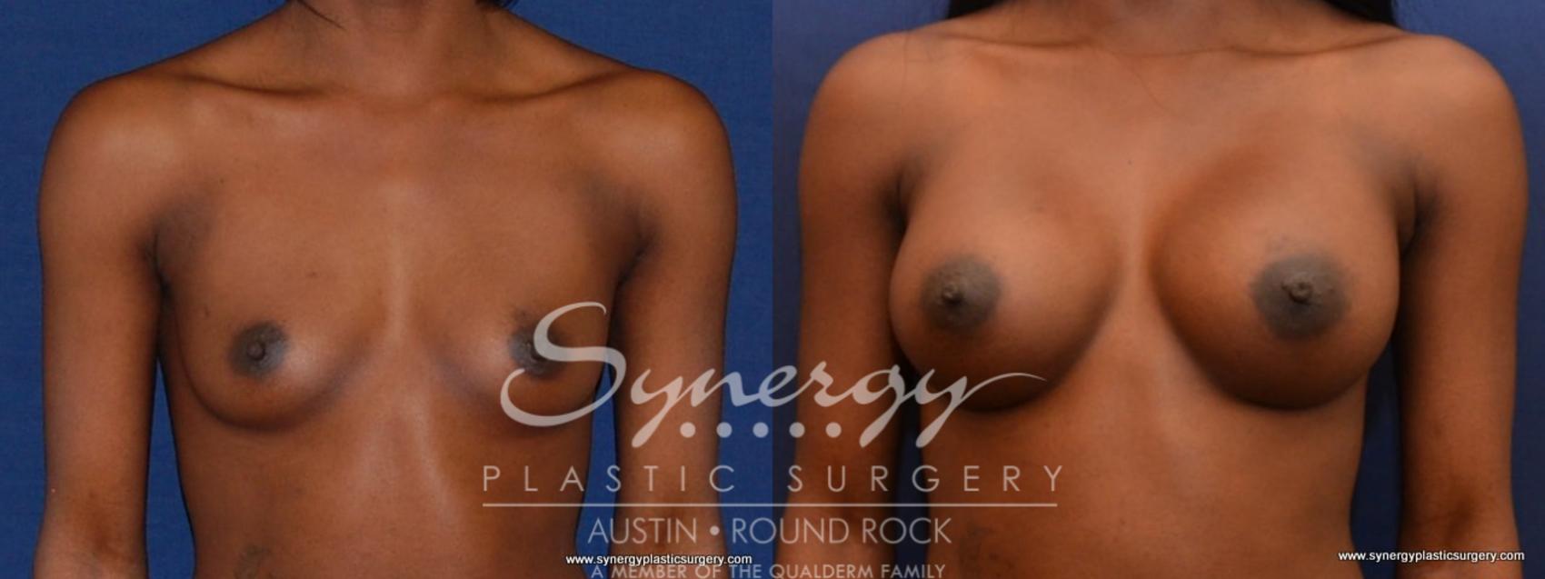 Before & After Breast Augmentation Case 458 View #1 View in Austin, TX