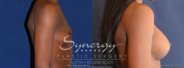 Before & After Breast Augmentation Case 458 View #2 View in Austin, TX