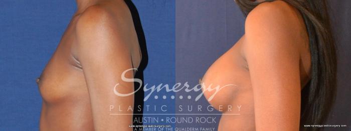 Before & After Breast Augmentation Case 458 View #4 View in Austin, TX