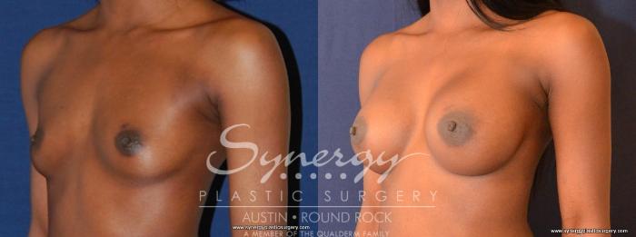 Before & After Breast Augmentation Case 458 View #5 View in Austin, TX