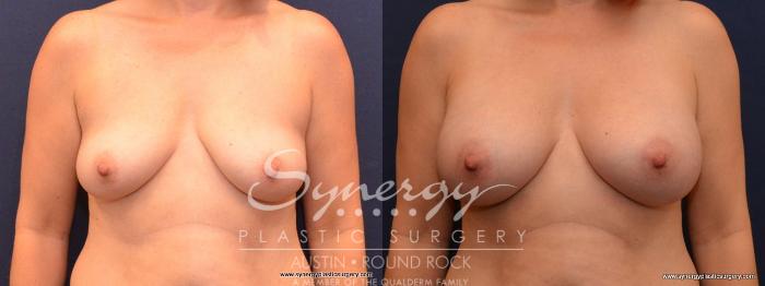 Before & After Breast Augmentation Case 459 View #1 View in Austin, TX