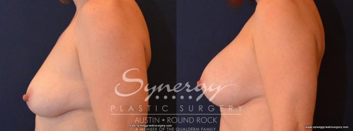 Before & After Breast Augmentation Case 459 View #2 View in Austin, TX