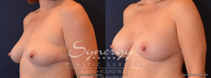 Before & After Breast Augmentation Case 459 View #3 View in Austin, TX