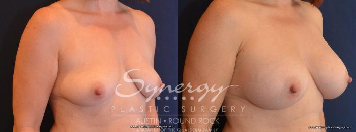 Before & After Breast Augmentation Case 459 View #4 View in Austin, TX