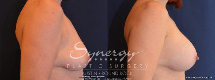 Before & After Breast Augmentation Case 459 View #5 View in Austin, TX