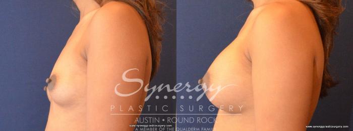 Before & After Breast Augmentation Case 461 View #2 View in Austin, TX