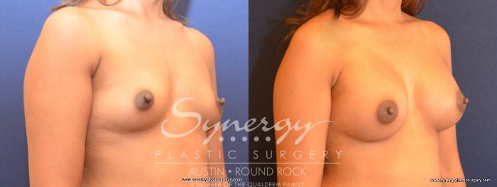 Before & After Breast Augmentation Case 461 View #3 View in Austin, TX