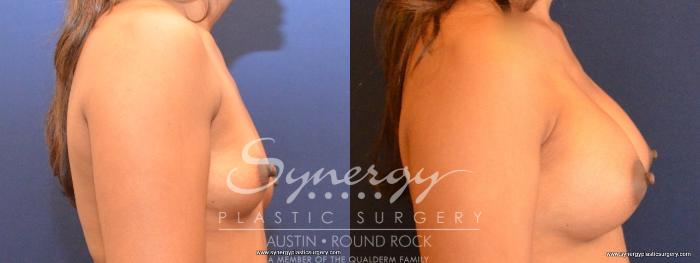 Before & After Breast Augmentation Case 461 View #4 View in Austin, TX