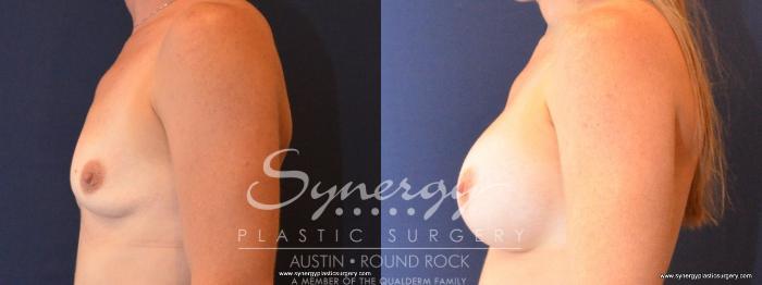Before & After Breast Augmentation Case 462 View #2 View in Austin, TX