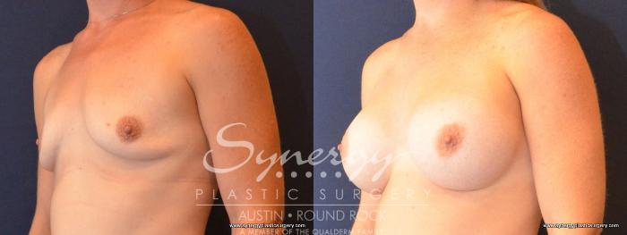 Before & After Breast Augmentation Case 462 View #3 View in Austin, TX