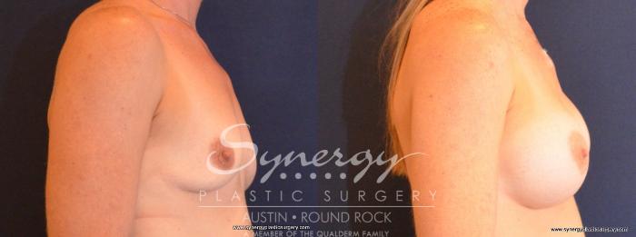 Before & After Breast Augmentation Case 462 View #4 View in Austin, TX