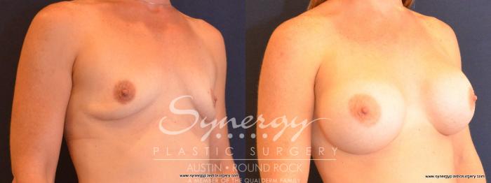 Before & After Breast Augmentation Case 462 View #5 View in Austin, TX