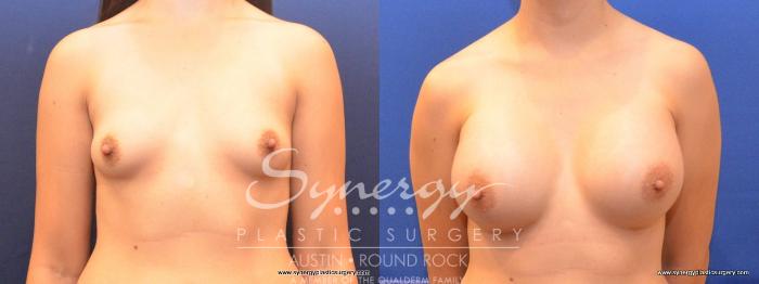 Before & After Breast Augmentation Case 464 View #1 View in Austin, TX