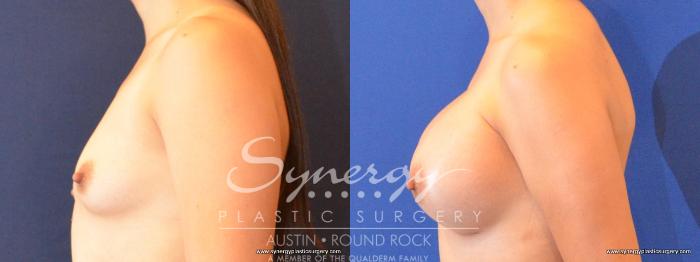Before & After Breast Augmentation Case 464 View #3 View in Austin, TX