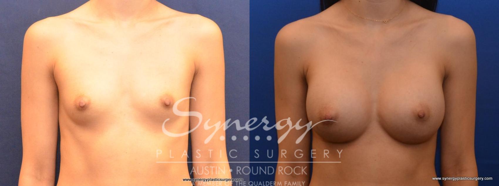 Before & After Breast Augmentation Case 466 View #1 View in Austin, TX