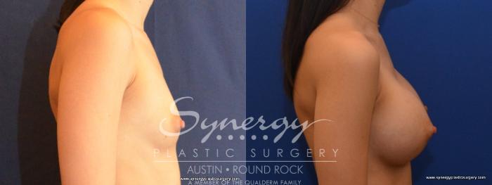 Before & After Breast Augmentation Case 466 View #3 View in Austin, TX