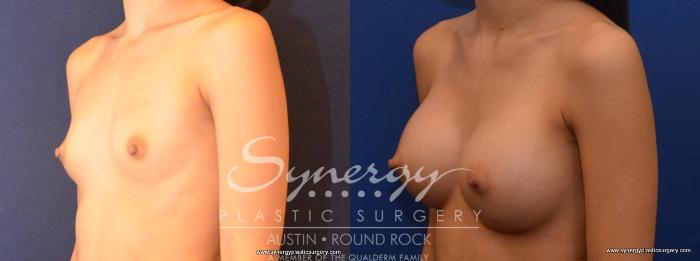 Before & After Breast Augmentation Case 466 View #4 View in Austin, TX