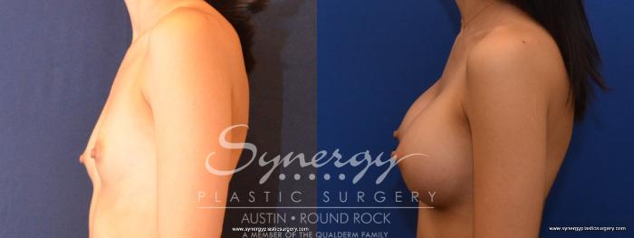 Before & After Breast Augmentation Case 466 View #5 View in Austin, TX