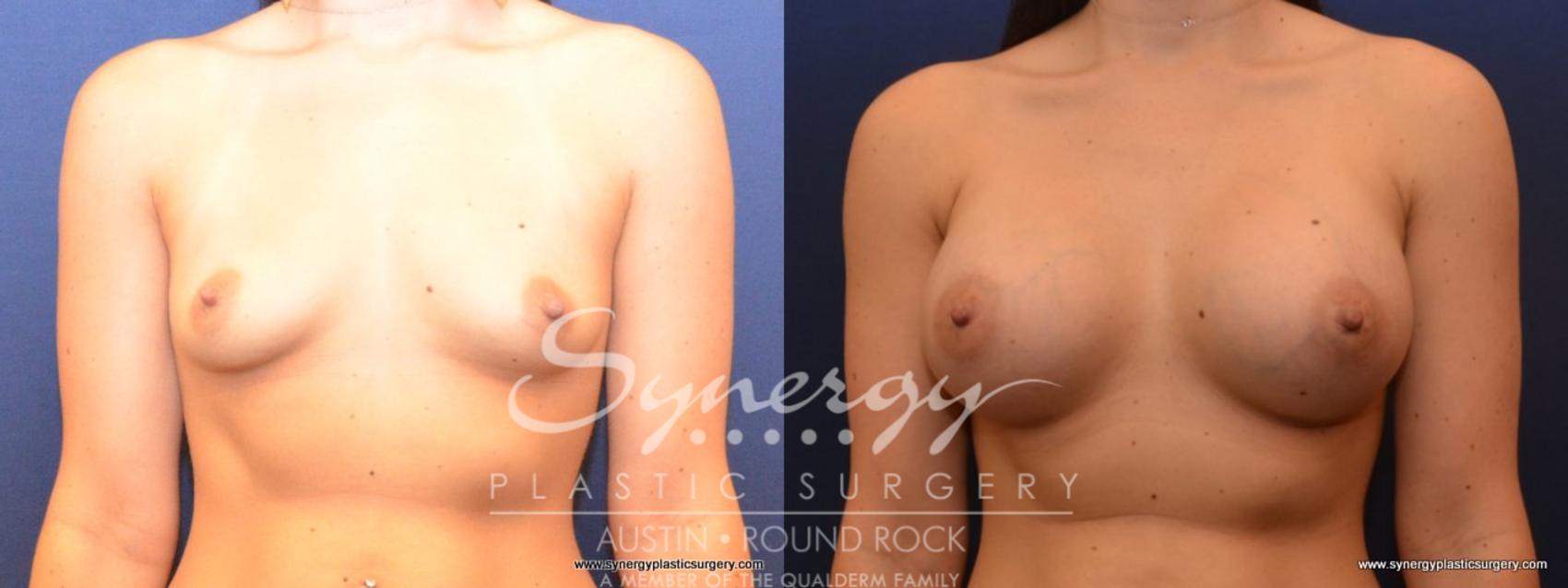 Before & After Breast Augmentation Case 468 View #1 View in Austin, TX