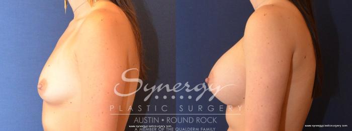Before & After Breast Augmentation Case 468 View #2 View in Austin, TX