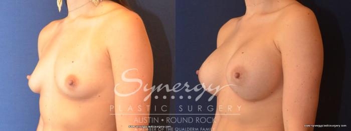 Before & After Breast Augmentation Case 468 View #3 View in Austin, TX