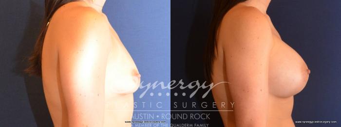 Before & After Breast Augmentation Case 468 View #4 View in Austin, TX