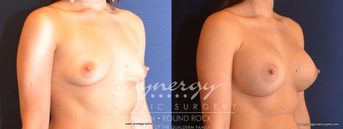 Before & After Breast Augmentation Case 468 View #5 View in Austin, TX