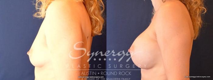 Before & After Breast Augmentation Case 474 View #3 View in Austin, TX