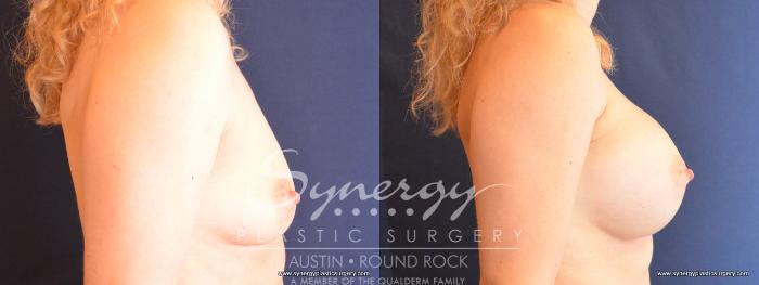 Before & After Breast Augmentation Case 474 View #5 View in Austin, TX