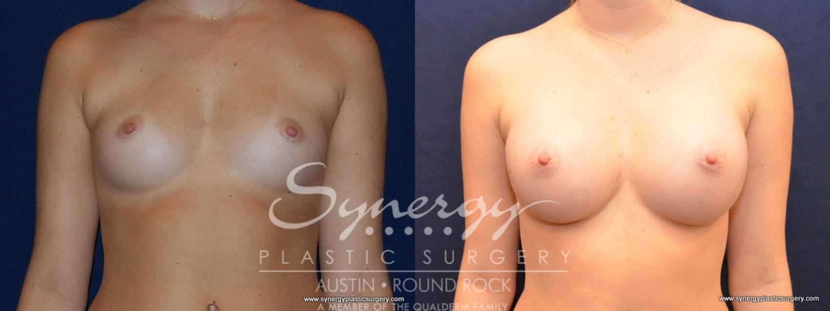 Before & After Breast Augmentation Case 475 View #1 View in Austin, TX