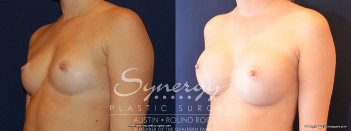 Before & After Breast Augmentation Case 475 View #2 View in Austin, TX
