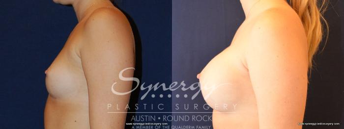 Before & After Breast Augmentation Case 475 View #3 View in Austin, TX