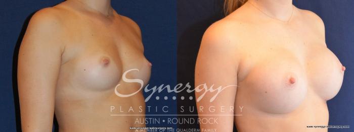 Before & After Breast Augmentation Case 475 View #4 View in Austin, TX