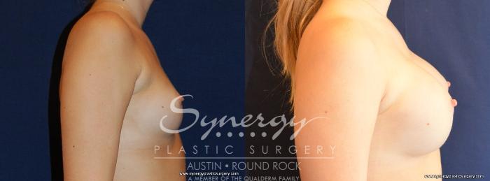 Before & After Breast Augmentation Case 475 View #5 View in Austin, TX