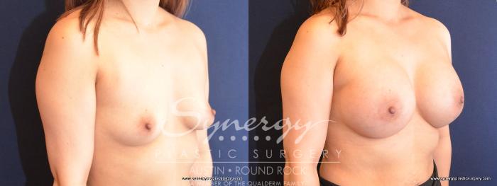 Before & After Breast Augmentation Case 476 View #2 View in Austin, TX