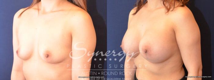 Before & After Breast Augmentation Case 476 View #5 View in Austin, TX