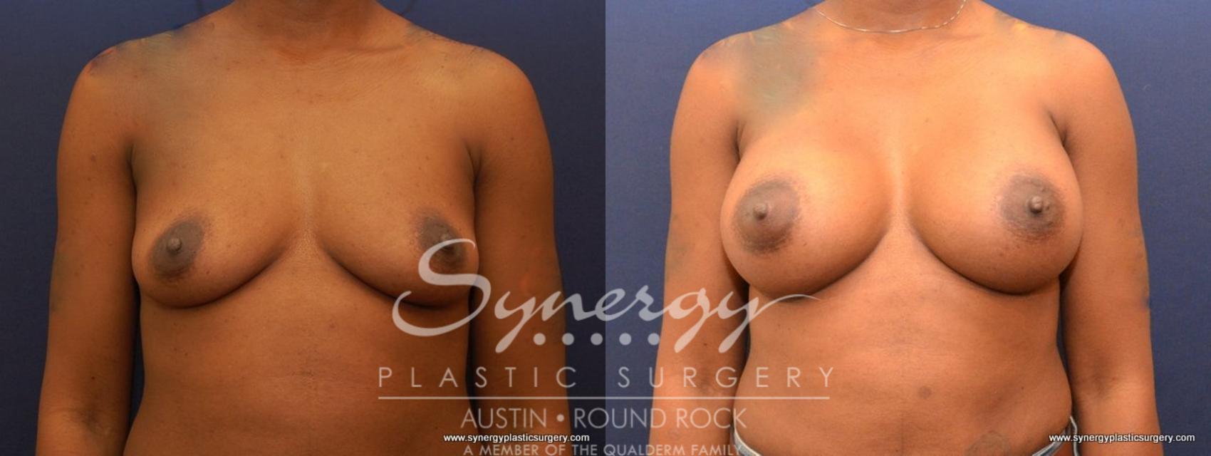 Before & After Breast Augmentation Case 477 View #1 View in Round Rock, TX