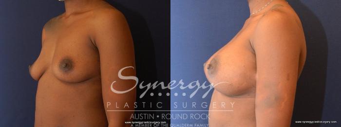 Before & After Breast Augmentation Case 477 View #2 View in Austin, TX