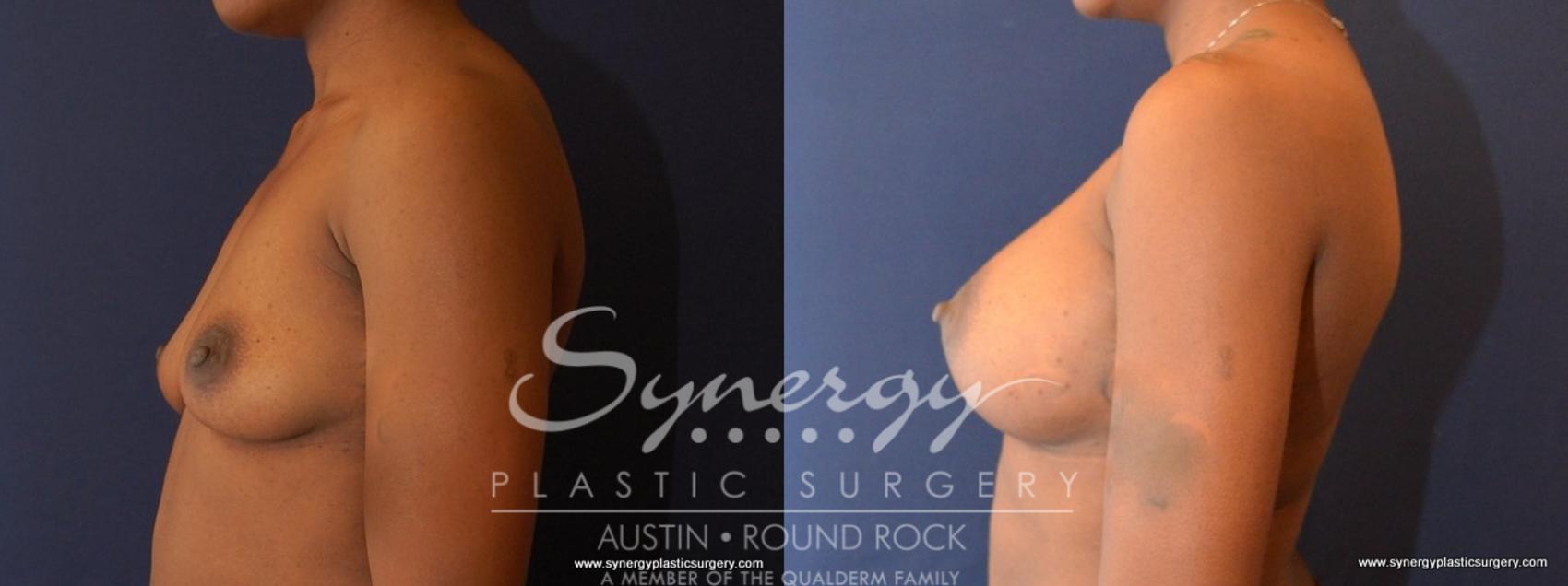 Before & After Breast Augmentation Case 477 View #3 View in Round Rock, TX