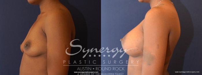 Before & After Breast Augmentation Case 477 View #3 View in Austin, TX