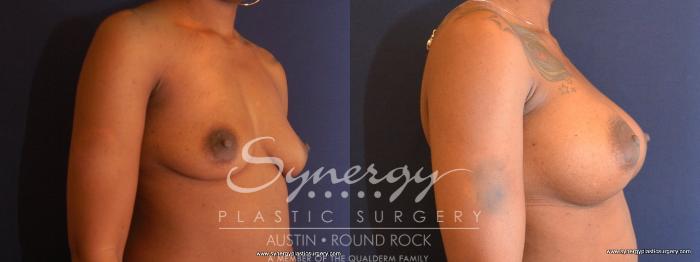 Before & After Breast Augmentation Case 477 View #4 View in Austin, TX