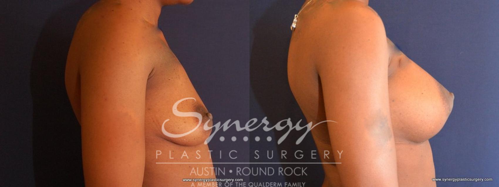 Before & After Breast Augmentation Case 477 View #5 View in Austin, TX