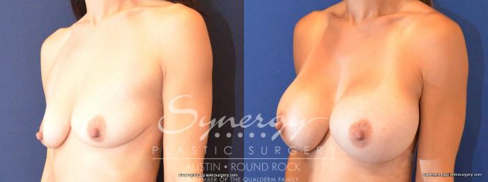 Before & After Breast Augmentation Case 478 View #2 View in Austin, TX