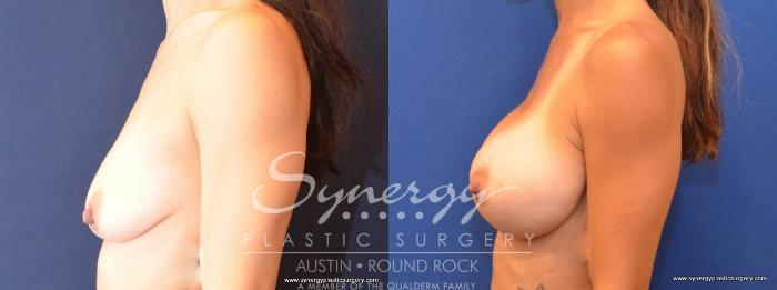 Before & After Breast Augmentation Case 478 View #3 View in Austin, TX