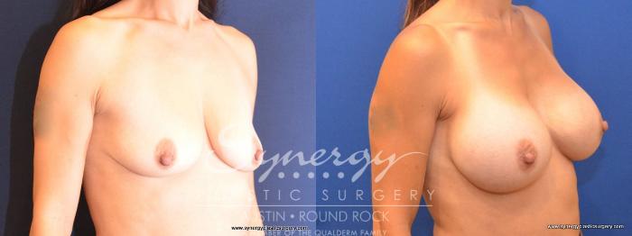 Before & After Breast Augmentation Case 478 View #4 View in Austin, TX