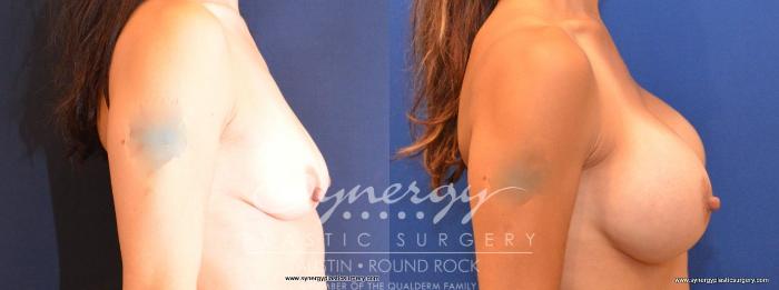 Before & After Breast Augmentation Case 478 View #5 View in Austin, TX