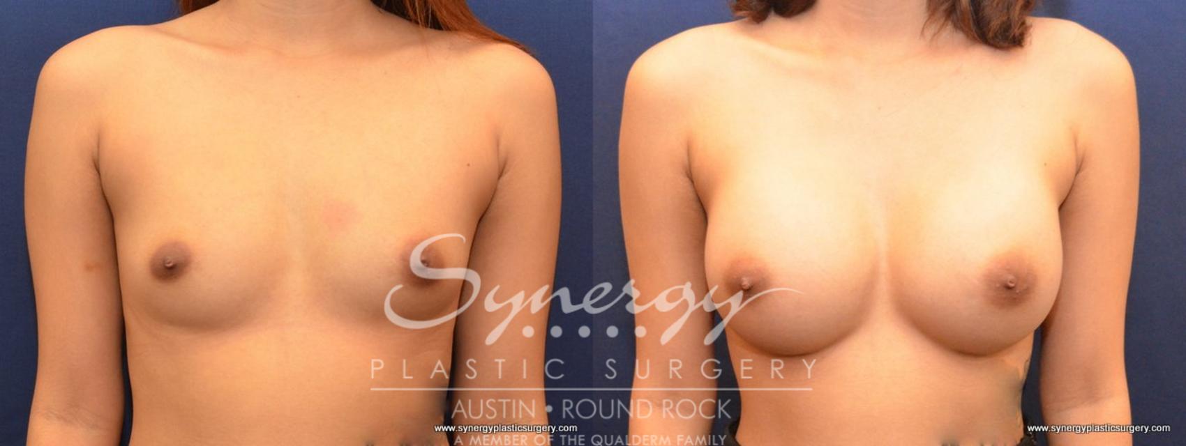 Before & After Breast Augmentation Case 480 View #1 View in Austin, TX